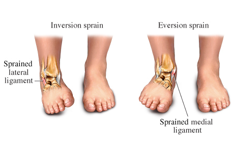 Ankle-Sprains